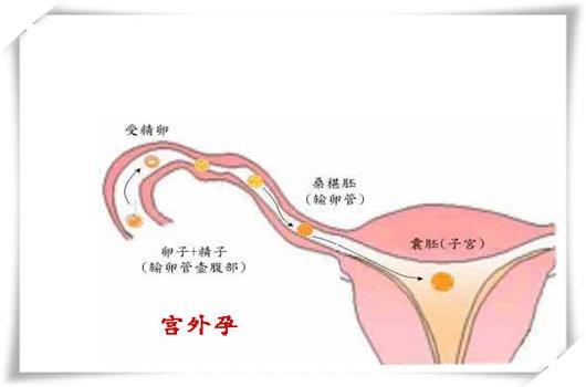 宮外孕怎麼治療最好（宮外孕的初期症狀）1