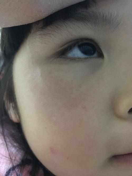 風吹臉上三歲小孩鼻梁周圍起斑（孩子面部出現紋理像化濃妝）1