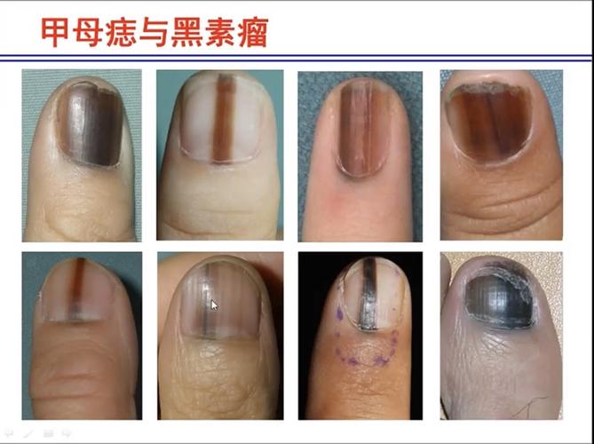 甲母痣和指甲黑色素瘤的區别（指甲長黑線當心黑色素瘤）1