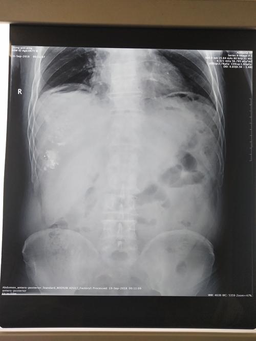 胃腸道穿孔的典型x線表現（胃腸道穿孔的影像學表現知識）1