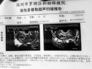 懷孕b超單顯示是圓的（酸兒辣女第一次B超檢查顯示）1