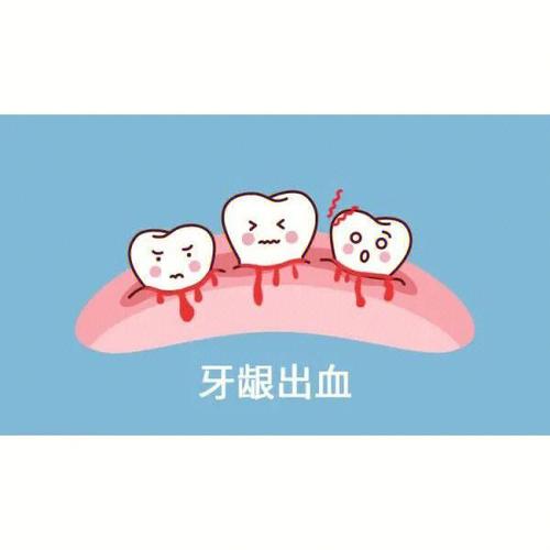 治療牙龈出血的小妙招（牙龈老出血怎麼回事）1