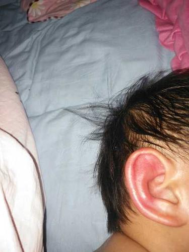 寶寶感冒耳朵後發紅是什麼原因（春天謹防兒童耳朵）1