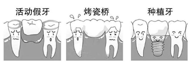 鑲牙的形式有幾種（短科普鑲牙的種類有哪些）1
