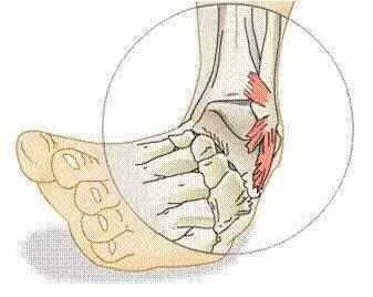 踝關節扭傷在什麼時候可以熱敷（踝關節扭傷後冷敷or熱敷）4