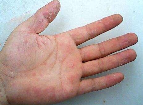 手掌出現小紅點是什麼病（這5個症狀可能與這些疾病有關）1