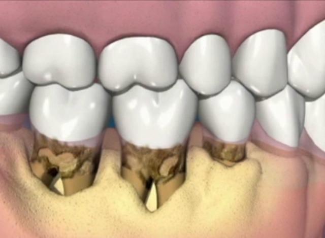 牙齒上長滿了牙結石怎麼弄掉（下颚的牙齒裡面有很多牙結石）2