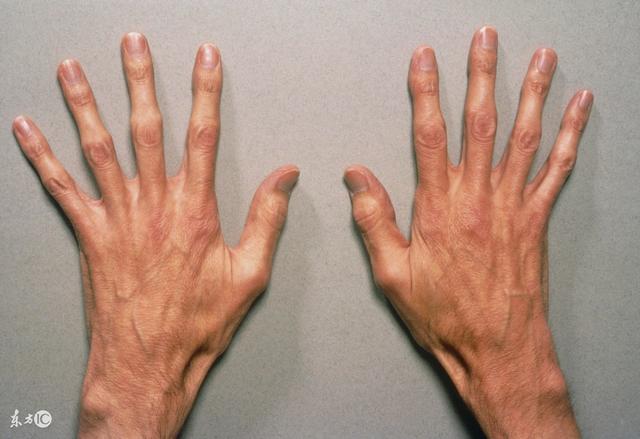手掌出現小紅點是什麼病（這5個症狀可能與這些疾病有關）2