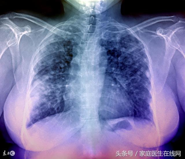 肺部有小結節如何保守治療（體檢發現肺部小結節要治療嗎）3
