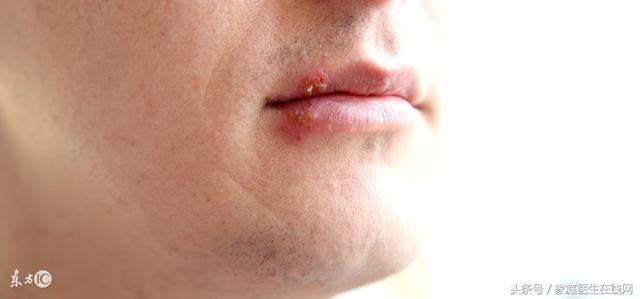 頑固性唇炎最佳治療方法（你還在用這三種方法來治療唇炎嗎）2