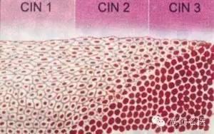 宮頸活檢cin級是不是一定得癌症（什麼是CIN宮頸上皮内瘤變）1