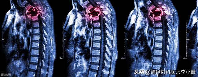 脊髓損傷康複可能遇到的困難（脊髓損傷後有沒有必要康複治療）1