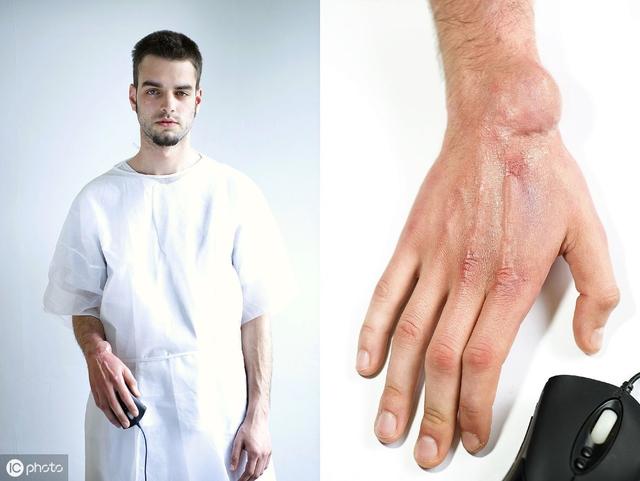 手指腱鞘炎為什麼叫鼠标手（辟謠:鼠标手就是腱鞘炎）6