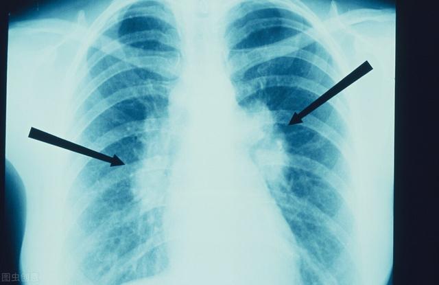 肺部結節大多數人都有嗎（肺部結節每個人都有）3