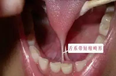 遺傳性牙颌畸形的主要表現方式（孩子的這20種牙颌畸形問題需要在12歲前解決）11