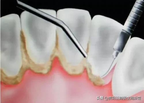 牙龈出血刷牙痛要不要洗牙（經常刷牙出血牙龈紅腫）7