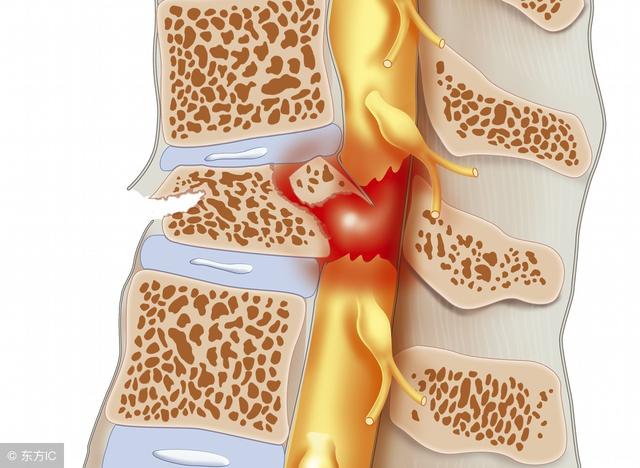脊髓損傷怎麼進行康複治療（要選用這5個方法治療）1