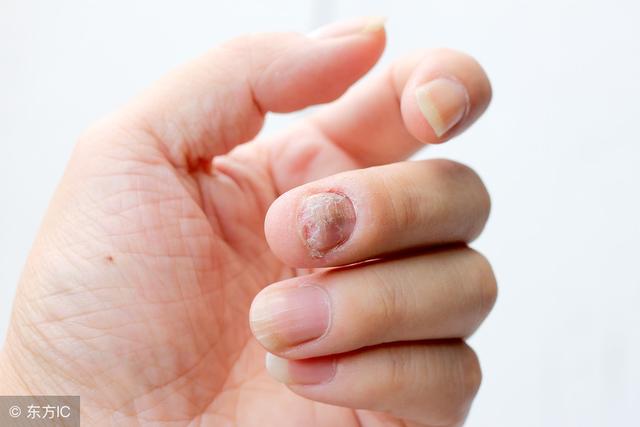 灰指甲是什麼原因造成的傳染嗎（灰指甲有6大症狀）3