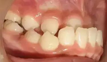 遺傳性牙颌畸形的主要表現方式（孩子的這20種牙颌畸形問題需要在12歲前解決）1