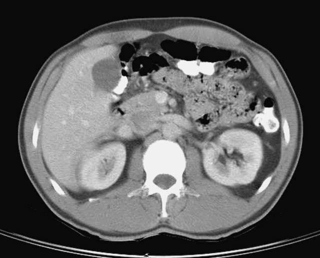 肝總管ct解剖位置（收藏上腹部CT斷層）31