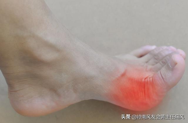 腳上痛風發作的位置有哪些（腳部容易引起痛風發作）3