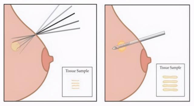 乳腺穿刺活檢與微創區别（什麼是乳腺穿刺活檢）3