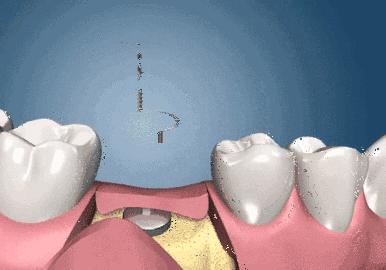 全口即刻種植牙的詳細步驟（即刻負重的種植牙）(2)