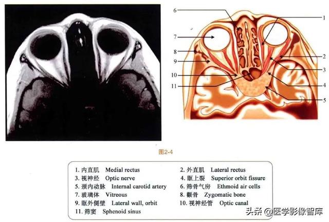 ct與mri斷層解剖學袖珍圖譜電子版（眼眶MRI斷層解剖速查圖譜）5