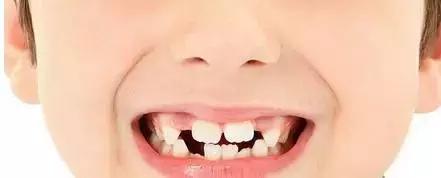 遺傳性牙颌畸形的主要表現方式（孩子的這20種牙颌畸形問題需要在12歲前解決）7
