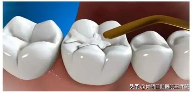 補牙需要每次補嗎（為什麼一次性不能補完呢）1