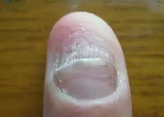 科普指甲型銀屑病與灰指甲的區别（指甲型銀屑病與灰指甲的區别）3