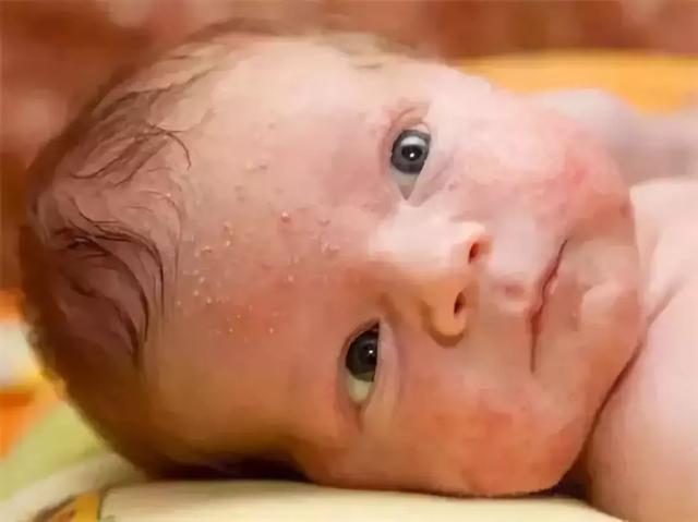 嬰兒為什麼會長痤瘡應如何解決（寶寶會長青春痘）2