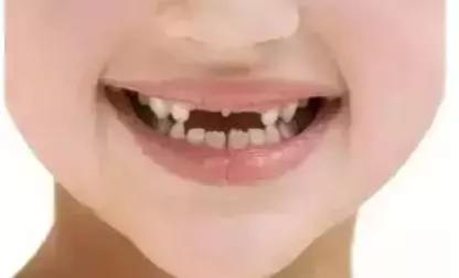 遺傳性牙颌畸形的主要表現方式（孩子的這20種牙颌畸形問題需要在12歲前解決）6