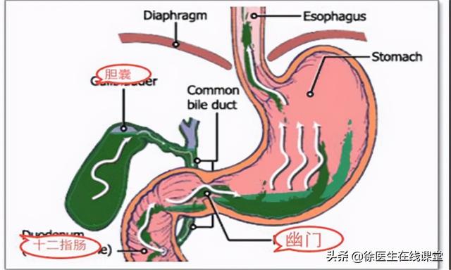 膽汁反流與胃食管反流的差别（膽汁反流與胃食管反流有何不同）8