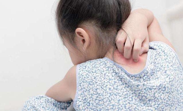 小孩濕疹用什麼方法治療好得最快（孩子濕疹久治不愈）3