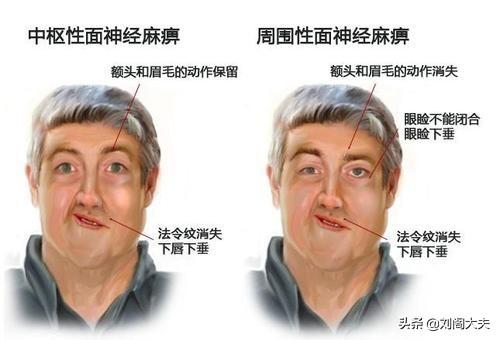 面癱如何緩解快速改善嘴歪眼斜（得了面癱我們應該怎麼治療）(2)