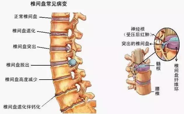 腰疼腿疼最快緩解方法簡單動作（腰疼腿腳麻不再反複）(1)