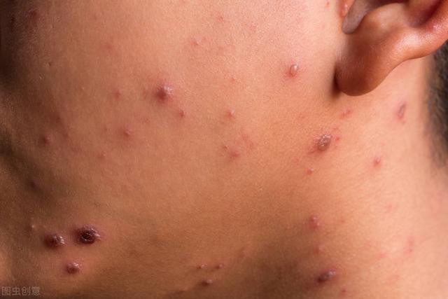 出現斑疹就一定是梅毒嗎（手上出現圓形斑疹）2