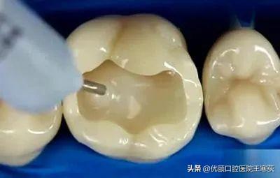 補牙需要每次補嗎（為什麼一次性不能補完呢）2