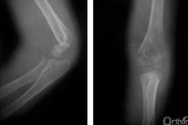 肱骨遠端全骺分離的治療方法（骨科常見疾病X線解析之肱骨遠端全骨骺分離）4