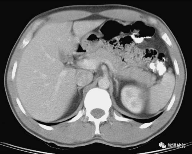 肝總管ct解剖位置（收藏上腹部CT斷層）19