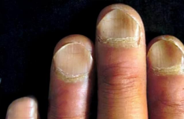 手指到底有月牙還是無月牙健康（手指月牙多和手指月牙少）4