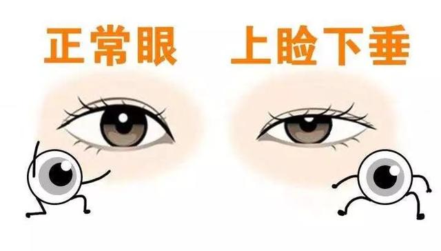 提眉還是雙眼皮（雙眼皮VS提眉）2