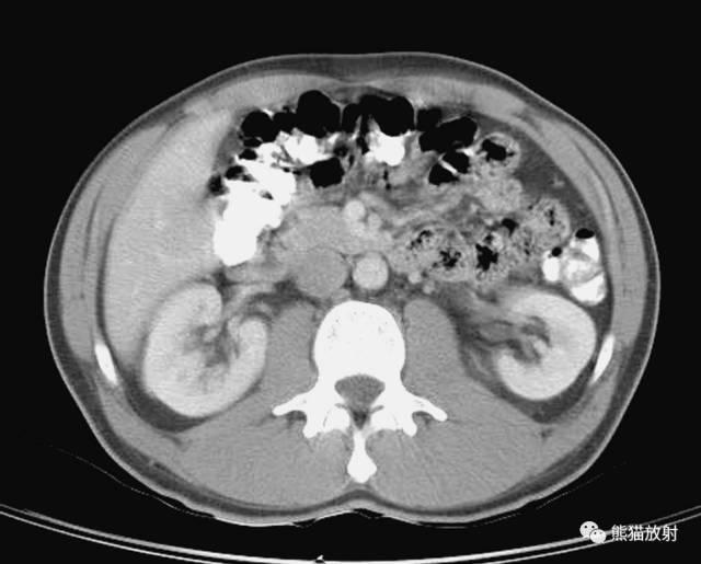 肝總管ct解剖位置（收藏上腹部CT斷層）42