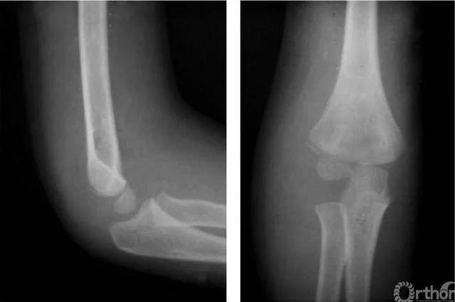 肱骨遠端全骺分離的治療方法（骨科常見疾病X線解析之肱骨遠端全骨骺分離）1