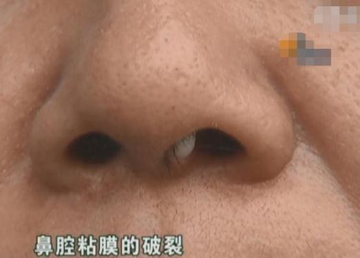 隆鼻手術失敗的真實案例（女子做隆鼻手術）4