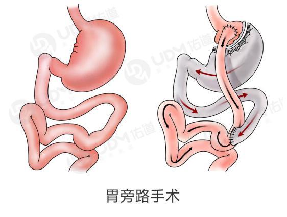 胃切除和胃轉流哪個效果好（胃轉流手術與胃切除手術哪個好）2