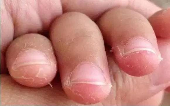 小孩手指起皮是缺什麼維生素（小孩手指脫皮不單是缺維生素）1