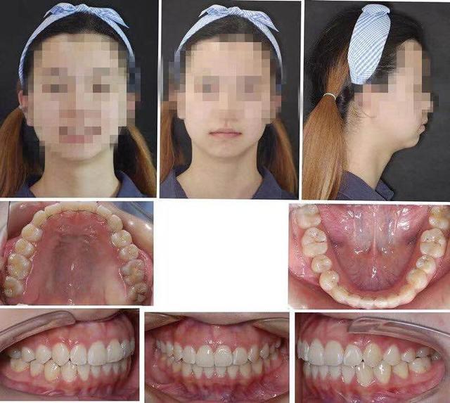 牙齒戴隐形的牙套矯正效果怎麼樣（低調進行牙齒矯正成新寵）1
