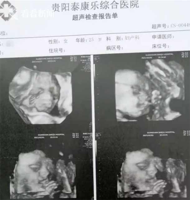 孕婦多久能檢查出畸形胎兒（懷孕33周多次産檢未發現胎兒畸形）2